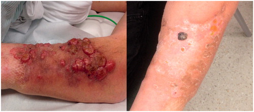 Figure 1. These images show a Merkel cell carcinoma before and 6 weeks after isolated limb perfusion. Almost all tumours have disappeared and the last necrotic tumour fell off; at 3 months there was no evidence of disease left. Image reproduced with permission from the patient.