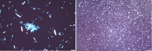 Figure 2. Urine microscopic evaluation showed numerous needle-shape polarizable crystals, morphologically compatible with calcium oxalate monohydrate crystals (Panel A 40X, Panel B 4X).