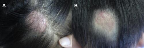 Figure 2 (A) Clinical manifestation of patient 2. (B) Complete remission after treatment of patient 2.