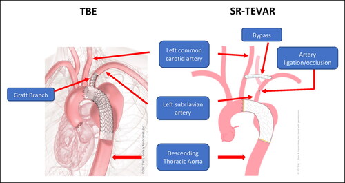 Figure 2. Anatomic description of thoracic branched endograft (TBE) vs SR-TEVAR (thoracic endovascular aortic repair with extra-anatomic debranching of the left subclavian artery). Anatomic illustrations courtesy of WL Gore & Associates.