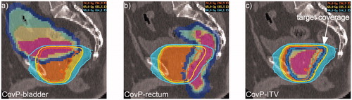 Figure 2. CovP-IMRT plans. The CovP-plan was calculated based on three consecutive planning CTs implementing deformation and movements of OAR and CovP-ITV. The CovP is demonstrated for bladder (a), rectum (b) and the ITV (c). Coverage probability is visualized by colors (pink = three times, yellow = twice, green = once). Blue demonstrates the safety margin of 7mm for CovP-ITV and OARs.