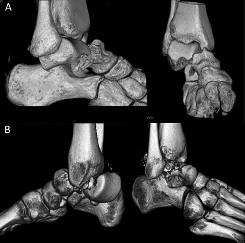 Figure 2. 3-D CT reconstruction of fracture types represented in the study population: Hawkins type 2b (A) and type 3 (B).