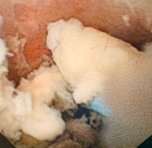 Figure 2 Endoscopic findings related to the infected kidney stone.