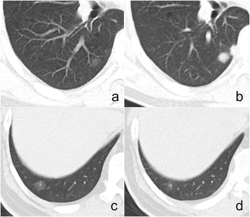 Figure 2 A 57-year-old man with an incidental GGN. (a) Axial CT image shows an 8-mm round and ill-defined pGGN with lower density (ΔCT = 105 HU) located in the right lower lobe. (b) Follow-up CT scan performed 3 months later shows this nodule increases in size and density and a new solid nodule occurs in the adjacent lung field. Histopathologic analysis reveals granulomatous inflammation caused by cryptococcal infection. A 59-year-old man with diabetes and hepatitis B, and a smoking history of 20 years. (c) Axial CT image shows a 12-mm round and well-defined PSN with smooth margin located in the right lower lobe. (d) Follow-up CT scan performed one month later shows the nodule decreases in density. Histopathologic analysis reveals granulomatous inflammation.