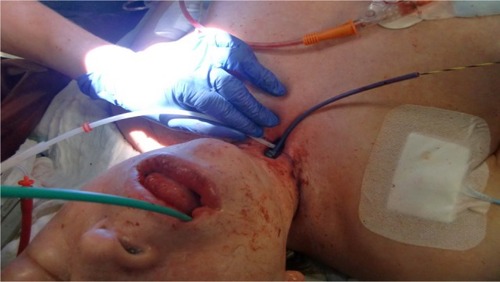 Figure 12 Continuous patient airway management with the help of a DLET over a jagwire introduced orally and lead out of the tracheal airways at the level of the percutaneous tracheostoma. Jet-catheter ventilation into the distal part of the FS.