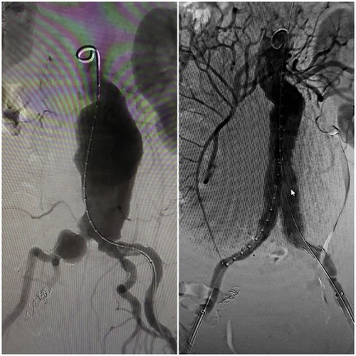 Figure 3 Intraoperative digital subtraction angiogram: (A) large infrarenal AAA with aneurysmal dilatation of right common iliac artery and short ectatic left common iliac artery, Magnification X1(B) successful deployment of the bifurcated graft and embolization of RIIA, Magnification X1.