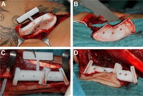 Figure 3 Transplant cutting guide.