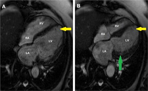 Figure 3 Cardiac magnetic resonance 4-chamber view of the left ventricle in diastole (A) and in systole (B) showing hypercontractility (green arrow) and typical apical ballooning (yellow arrow) in takotsubo syndrome.