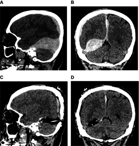 Figure 2 Pre- and post-operative CT images of the brain confirming evacuation of SDH and improvement of brain compression. (A, B) pre-, and (C, D) post-operative images (sagittal and coronal view, respectively).
