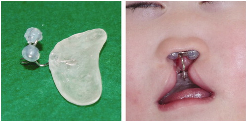 Figure 2. Naso-alveolar molding plate and its silicone globes, which support the nasal dome in the upward and forward direction.