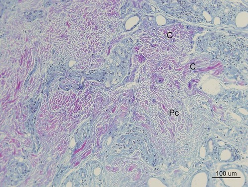 Figure 11 Herovici’s staining (100× magnification) in the same dermis area as the H&E stain in Figure 5. Herovici’s stain distinguishes red-stained mature reinforced collagen (C) and red-stained existing collagen (Pc) prior to filler injection from newly formed (young) collagen (blue). Around filler particles and giant cells, abundant new or immature collagen or type-3-Collagen and reticular fibers were observed and stained blue. The reinforced mature collagen (C) showed a thicker and irregular pattern, while pre existing collagen (Pc) showed a regular pattern with regular thickness.