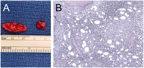 Figure 4. A. Intraoperative image showing the specimens from the left nasolabial fold and left marionette line. B. Hematoxylin-eosin stain showing lipogranulomas with granulomatous inflammation within the connective tissue stroma (20× magnification).