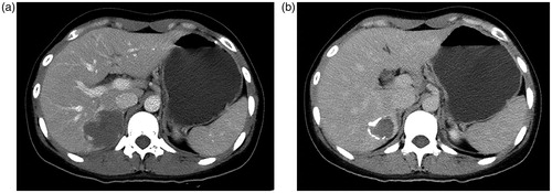 Figure 3. Pre-TAE (a) and one-year post-TAE and (b) CT examinations show a significant reduction in size of hemangioma after TAE treatment.