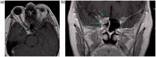 Figure 2. (a) MRI scan shows that inflamed tissue spread to the orbital apex and encircled the optic nerve. (b) Coronal MRI scans support the sagittal images.