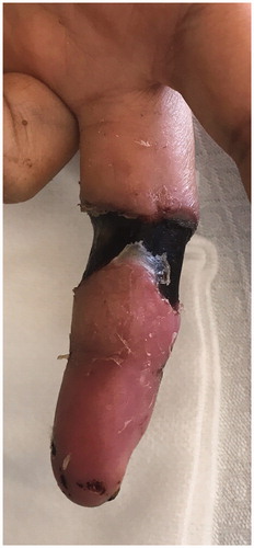 Figure 7. Skin with deep necrosis ulcers (12th day post-trauma - volar view).