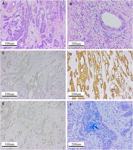 Figure 3 (A and B) Hematoxylin and eosin (H&E) staining revealed the tumors consisted of epidermoid cells, intermediate undifferentiated cells, and mucous cells. (C–F) Immunohistochemical studies show positivity for P40 (Anti-P40 Antibody, MABS519-AF647), CK7 (Anti-Cytokeratin-7antibody, SAB5600093), P63 (Anti-P63 Antibody, HK5257) and AB-PAS (AB-PAS staining kit, HZ-0127), respectively.