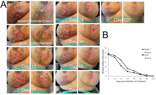 Figure 5. Treatment of large full-thickness wounds in the breast with topical application of hypoxia preconditioned serum (HPS) obtained from the patient’s peripheral blood. (a) Image panel showing the progression of a wound healing complication in the left and right breast that developed as a result of an inflammatory reaction following a breast reduction procedure in a 27-year-old female patient. Initial wound surface area was 23 and 24 cm2 in the left and right breast, respectively. Complete wound closure was achieved at 80 days post-debridement and initiation of treatment with daily application of an emulsion containing 10% HPS. Debridement refers to surgical excision of necrotic tissue deep-down to well-perfused layers. The number of days indicated is counted from the time point of first treatment application. Bars= 1 cm. (b) Plot showing the wound surface area, measured by image analysis, vs. time (days post-initiation of treatment).
