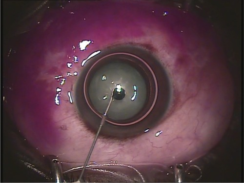 Figure 1 Air-filled anterior chamber with a Trypan blue drop held in the bevel of the needle.