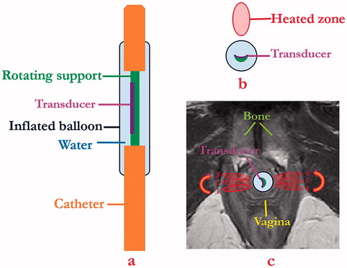 Figure 1. Schema showing (a) coronal and (b) axial diagrams of transurethral ultrasound applicator and placement (c) for delivery of precision thermal therapy to lateral zones off the female mid-urethra for the treatment of SUI. (c) The position of urethral transducer, sequential rotation directions, and sonications with the order from 1 to 3 on one side and 4 to 6 on the opposite side represent a proposed heating strategy, with heated zones shown in red contours.