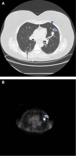 Figure 2 Spiculated nodule in the left upper lobe (arrow in A) with associated 18-FDG uptake on positron emission tomography scan (B), consistent with lung cancer.