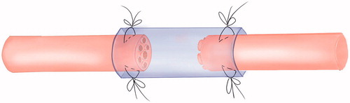 Figure 1. The tubulization method for peripheral nerve mutilation using biodegradable conduit.