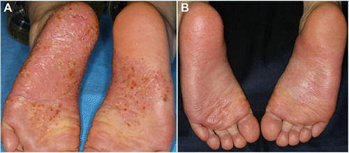 Figure 4 Clinical improvement of plantar PPP lesions before (A) and after (B) guselkumab therapy.