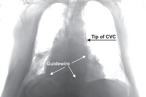 Figure 1 Chest radiograph showing the left parasternal location of the central venous catheter (CVC) with a guidewire retained in the right atrium through the PLSVC and the coronary sinus (brightness and contrast changed for better visualisation of the guidewire).