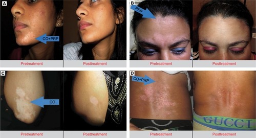 Figure 2 Variable results of improvement of vitiligo.