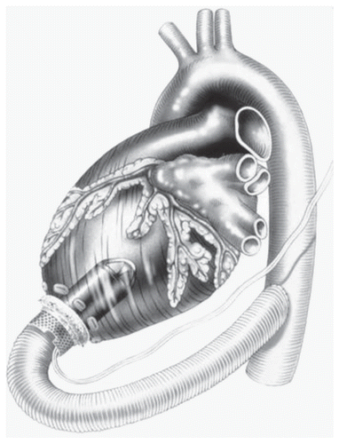 Figure 7 Jarvik 2000 LVAD, reproduced with permission from Jarvik Heart, Inc.
