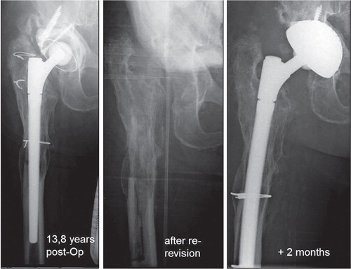 Figure 5. A 75-year-old male patient with periprosthetic infection 13.8 years after revision surgery. Explantation with a femoral fenestration and a wide debridement was performed. Two months later, the infection consolidated; thus, a re-revision with a curved MRP stem and a cementless cup could be performed. The previously performed fenestration was secured with 2 wires around the femur.