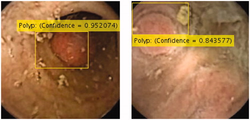 Figure 6. Polyp localization using region CNN deep learning detector and the confidence measure.