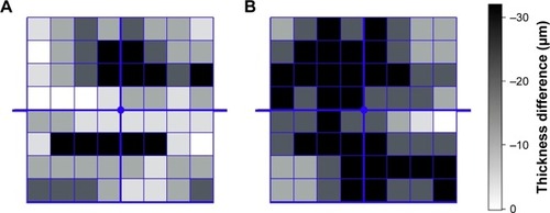Figure 5 Thickness difference map of controls compared to (A) normal UAE group and (B) microalbuminuric group.