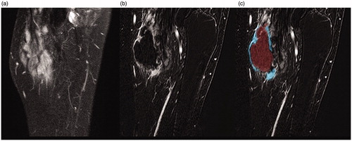 Figure 1. (a) MRI (T1 FS SPIR sequence with contrast) of popliteal fossa before treatment. (b) Subtraction sequence with contrast directly post-HIFU. (c) Post-processing of lesion with tumor tracking tool. Note that due to (unfortunate) different angulation of MR-sequences pre- and post-contrast the bone is not in the same plane as the tumor in the pre-contrast sequence.