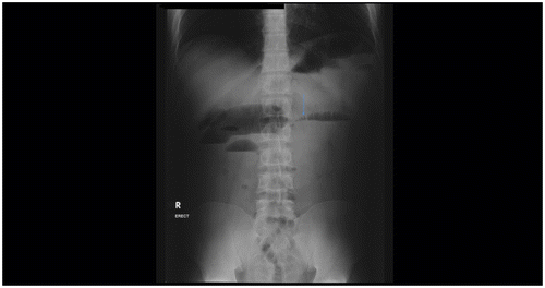Figure 2: Erect abdominal radiograph: Small bowel dilatation with multiple air fluid levels at different heights with string of beads sign (arrow) in keeping with definite small bowel obstruction