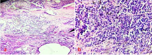 Figure 1. Haematoxylin and eosin staining a: Oral cancer b: Inflammatory lesion.