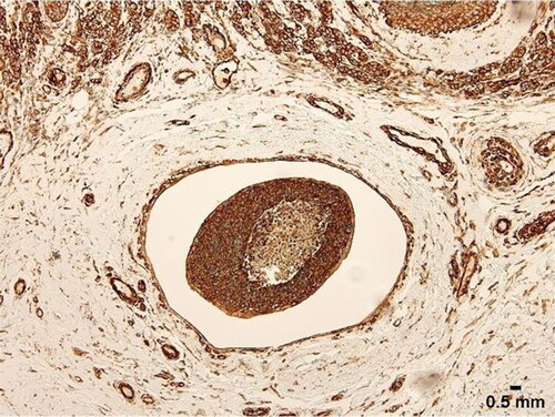 Figure 8. Tumour embolus with strong FLNA expression. Note necrosis at centre of embolus. Scale bar = 0.5 mm.