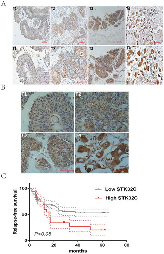 Figure 2. Immunohistochemistry. (a) Typical staining of STK32C in different stages of BC, a stronger density of staining existed in more invasive BC. (b) Nucleus and cytoplasm of tumor cells was dyed. The arrows and circles referred to the positively stained nucleus. Higher pathologic T stage of BC tended to be more easily stained in the nucleus. (c) Kaplan-Meier analysis was used to analyze the relapse-free survival (RFS) of patients treated by TURBT. High expression of STK32C was associated with a poor RFS with a P < 0.05.