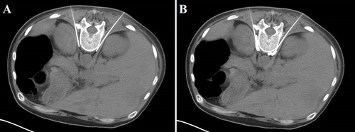 Figure 1 Anatomy of percutaneous retrocrural splanchnic neurolysis. Bilateral posterior antecrural approach splanchnic neurolysis performed in a 43 years old woman with metastatic liver cancer and intractable abdominal pain. (A) Needle tips were positioned immediately in the T12 to L1 prevertebral space and the posterolateral aspect of abdominal aorta. (B) The dilute contrast was injected through each needle to confirm position.