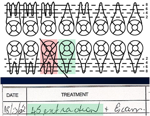 Figure 1. In the dental record, tooth 45 (lower right second premolar, shaded green in the odontogram and treatment notes) is recorded as having been extracted, but it is tooth 46 (shaded in pink) that has been crossed out. We cannot resolve this problem without further information or images such as X-rays. (Image courtesy Health Support Queensland Forensic and Scientific Services (HSQ FSS) and the Queensland State Coroner, with permission).