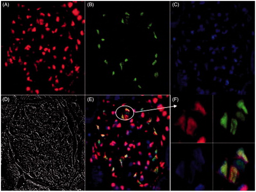 Figure 1. Cabin1 localized in the nuclei of glomerular innate cells of normal rats. Notes: A–E:original magnification: ×400; F: ×1500) (A) Cabin1 mainly localized in the nuclei of glomerular innate cells; (B) WT-1 localized in podocytes nuclei; (C) nuclei; (D) Differential interference contrast (DIC); (E and F) Cabin1 and WT-1 colocalized in podocytes nuclei.