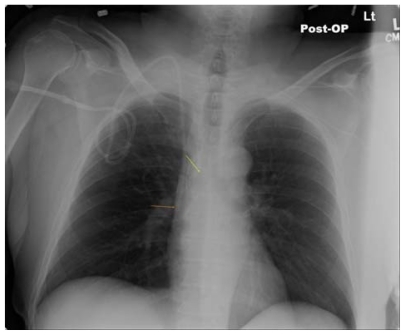 Figure 1 Long-term right internal jugular venous catheter (tip at orange arrow) appropriately positioned relative to right tracheobronchial angle (at yellow arrow).