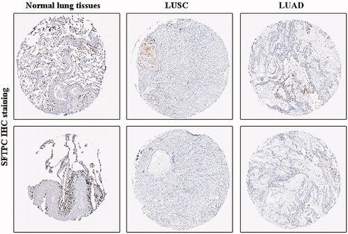 Figure 3. SFTPC protein expression was significantly lower in both LUAD and lung squamous carcinoma (LUSC) tissues in comparison with normal lung tissues. SFTPC immunohistochemistry (IHC) staining images: in normal lung tissues (left), in LUSC tissues (middle), and in LUAD tissues (right). Images were downloaded from the Human Protein Atlas (HPA) (http://www.proteinatlas.org/).