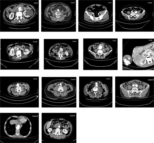 Figure 1 CT/CTA imaging findings in 14 patients with aneurysm due to brucellosis. Case 1: Moderate luminal stenosis from the bilateral common iliac arteries to the proximal femoral arteries and occlusion of the proximal right internal iliac artery; Case 2: High-density changes in the para-abdominal aorta; Case 3: Hypointense shadow around the bifurcation of the lower abdominal aorta near the common iliac artery; Case 4: Wall notch and posterior aneurysmal contrast filling of the posterior wall of the left common iliac artery proximal to the opening of the left internal iliac artery; Case 5: Longitudinal cystic inclusion in the right retroperitoneum; Case 6: Progressive enlargement of the distal abdominal aorta; Case 7: A low-density mass shadow visible between the common iliac arteries bilaterally and occlusion of the right proximal internal iliac artery; Case 8: Contrast ectasia with irregular morphology outside the distal brachial artery of the right upper limb, with no visualization of the distal brachial artery; Case 9: Limited aneurysmal dilatation of the lower abdominal aorta and limited moderate-severe stenosis of the proximal internal iliac arteries bilaterally; Case 10: Limited aneurysmal protrusion of the lumen at the beginning of the left common iliac artery, mild stenosis of the lumen at the beginning of the superior mesenteric artery and the left renal artery; Case 11: Oval cystic lesion in the right external iliac vessel travel area; Case 12: Localized thickening of the left common iliac artery at the lower branch of the abdominal aorta, High density shadows can be seen in the lumen of the upper abdominal aorta; Case 13: An annular low-density shadow can be seen next to the lower thoracic aorta stent; Case 14: Multiple exudations and soft tissue density shadows around the bilateral iliac artery and abdominal aorta.