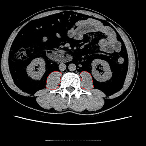 Figure 2 Cross-sectional CT images at the L3 vertebra level. The psoas muscle borders were manually outlined.