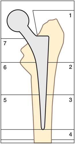 Drawing of a DXA scan of the proximal femur, showing the 7 Gruen zones around a femoral stem.