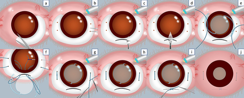 Figure 1 Illustration of step-by-step surgical procedures. (a) Conjunctival peritomy. (b) An infusion cannula is inserted at infero-temporal and 4 scleral markings are made. (c) 6 mm scleral tunnel incision at superior sclera. (d) Internal corneal incision connecting the tunnel and anterior chamber. (e) Polypropylene 8–0 sutures are inserted into each lens eyelet. (f) IOL is positioned in a correct intraocular position at the entrance of the tunnel and each thread is pulled and externalized from each sclerotomy using a micro-forceps. (g) IOL is inserted and the suture is tightened evenly until the IOL is central. (h) The sutures are tied, and the knots are rotated and internalized through the sclerotomy sites. (i) Suture the scleral tunnel. (j) Suture the conjunctiva.