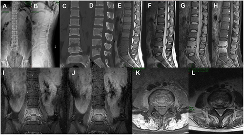 Figure 1 Radiological studies before operation. Plain radiograph showed narrowing of lumbar space 4–5 (A and B). CT showed dense pore-like destruction of the 4–5 lumbar vertebrae and intervertebral discs (C and D). Sagittal MRI showed vertebral and intervertebral disc lesions with low signal in T1, high signal in T2, and high signal in fat compression image, which was significantly enhanced after enhancement (E–H). Coronal MRI demonstrates a large, marked paravertebral abscess with unclear margins and enhancement (I and J). Axial MRI showed destruction of vertebral bodies and intervertebral discs, and significant strengthening of psoas after enhancement (K and L).