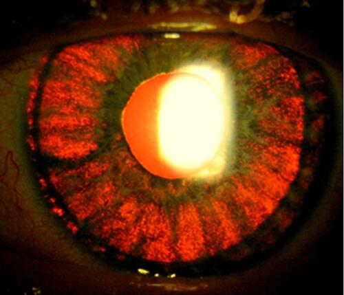 Figure 3 Typical picture of bilateral acute iris transillumination (BAIT) syndrome with iris transillumination on slit lamp examination and pupil deformation with associated semi-mydriasis. Notes: Picture reproduced from Perone JM, Reynders S, Sujet-Perone N, et al. Le syndrome de transillumination bilatérale aiguë de l’iris: case report [Bilateral acute iris transillumination: case report]. J Fr Ophtalmol. 2017;40(8):713-716. French. Copyright 2017, Elsevier Masson SAS. All rights reserved.7