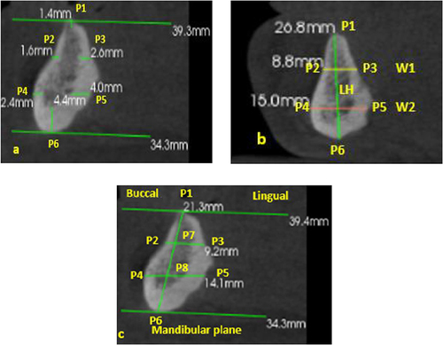 Figure 1 The symphysis section and the studied measurements. a-Cortical thickness; P1, the crest of the ridge; P6, the base of the mandible; P2, the upper buccal; P3, the upper lingual; P4, the lower buccal; and P5, the lower lingual. b-HL, the total height; W1, width of the upper third; and W2, width of the lower third. c-densities of the bones were measured at positions P1, P6, P7, and P8.