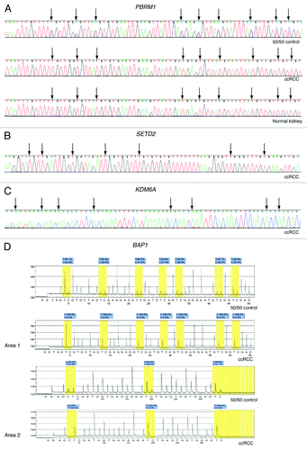 Figure 2. Representative examples of bisulfite sequencing and pyrosequencing. (A) Bisulfite direct sequencing of PBRM1 in 50:50 unmethylated:fully methylated DNA control, a ccRCC and normal renal parenchyma. Methylation is visible as a cytosine peak superimposed on a thymine peak at CpG loci indicated by black arrows in the 50:50 control. (B) Bisulfite direct sequencing of the reverse strand of KDM6A in ccRCC. (C) Bisulfite direct sequencing of SETD2 in a ccRCC. (D) Bisulfite pyrosequencing of two areas of the BAP1 promoter CpG island in the 50:50 control and a ccRCC.